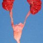 Persistence of renal lobulation in trisomy 21