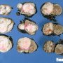 Wilms tumor. Macroscopy