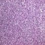 Monophasic synovial sarcoma