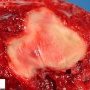 Placental intervillous thrombus