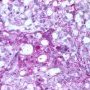 Yolk sac tumor