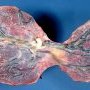 Bilobated placenta