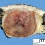 Lobular capillary hemangioma