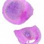 Appendiceal carcinoid tumor