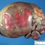 Spleen