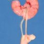 Horseshoe kidney (Fetus, 20 weeks)