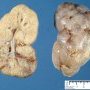 ARPKD kidney in a neonate (1 month)