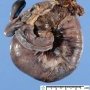 Intestinal intussuspection and infarction on Meckel diverticula