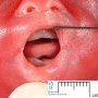 Microstomia in trisomy 21 (22 weeks)