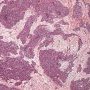 Abdominal desmoplastic small round cell tumor