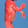 Turricephaly by intracranial neuroectodermal cyst