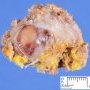 Localized neurofibroma in neurofibromatosis type 1 (NF1)