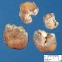 Colonic Peutz-Jeghers polyp