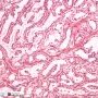 Clear cell papillary renal cell carcinoma