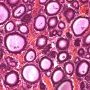 Pancreatic acinar cell carcinoma