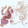 Vas deferens and epididymal duplication