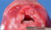 Bilateral lip/palate clefts