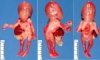 Gastroschisis-spina bifida association (18 weeks)
