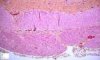 Colonic aganglionosis