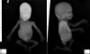 Caudal regression syndrome with lumbosacral agenesis