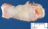 Enchondroma in Maffucci syndrome