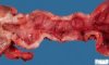 Crohn ileitis (Ileal Crohn disease)