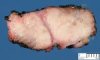 Sacrococcygeal teratoma (Macroscopy)
