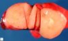 Pulmonary inflammatory myofibroblastic tumor