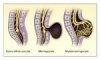 Spina bifida (NEJM)