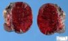 Testicular hemorrhagic necrosis by spermatic cord torsion
