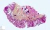 Lingual lymphangioma