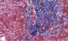 Portal fibrosis and biliary ductular proliferation in juvenile (...)