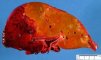 Hepatic ischemia in a liver allograft