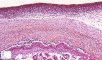 Infiltration of amnion by granulocytes in acute chorioamnionitis