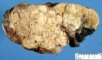 Hepatoblastoma after formalin fixation