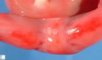 Anal imperforation in caudal regression sequence