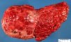 Macronodular cirrhosis and hepatocellular carcinoma in tyrosinemia