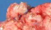 Sacrococcygeal teratoma (SCT) (Macroscopy)
