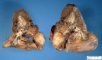 pulmonary osteosarcoma metastasis