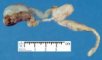 Obstructive solitary kidney with ureteral dilatation (22 weeks)
