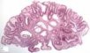 Tubulous microadenoma in FAP