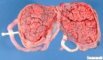 Placenta in diamniotic dichorionic twin pregnancy