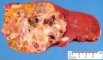 Hepatoblastoma