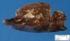 Bronchial mucocele in bronchial atresia