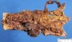 Colonic lymphangioma