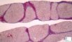 Cirrhosis