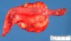 Mesenteric lipoma