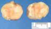 Caseous necrosis in mycobacterial adenitis