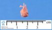 Pre-ductal aortic coarctation