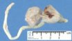 Anorectal agenesis with rectovesical fistula